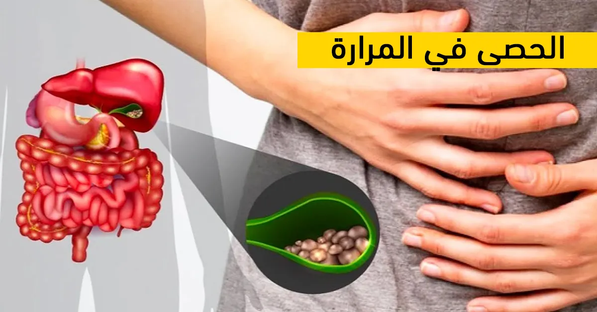 الحصى في المرارة